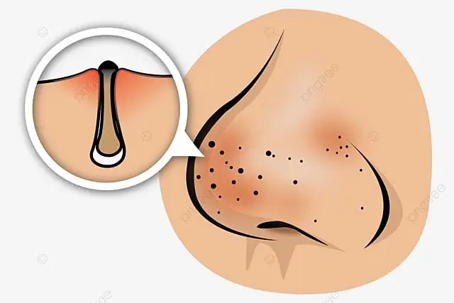 For Nose Pores Specifically
